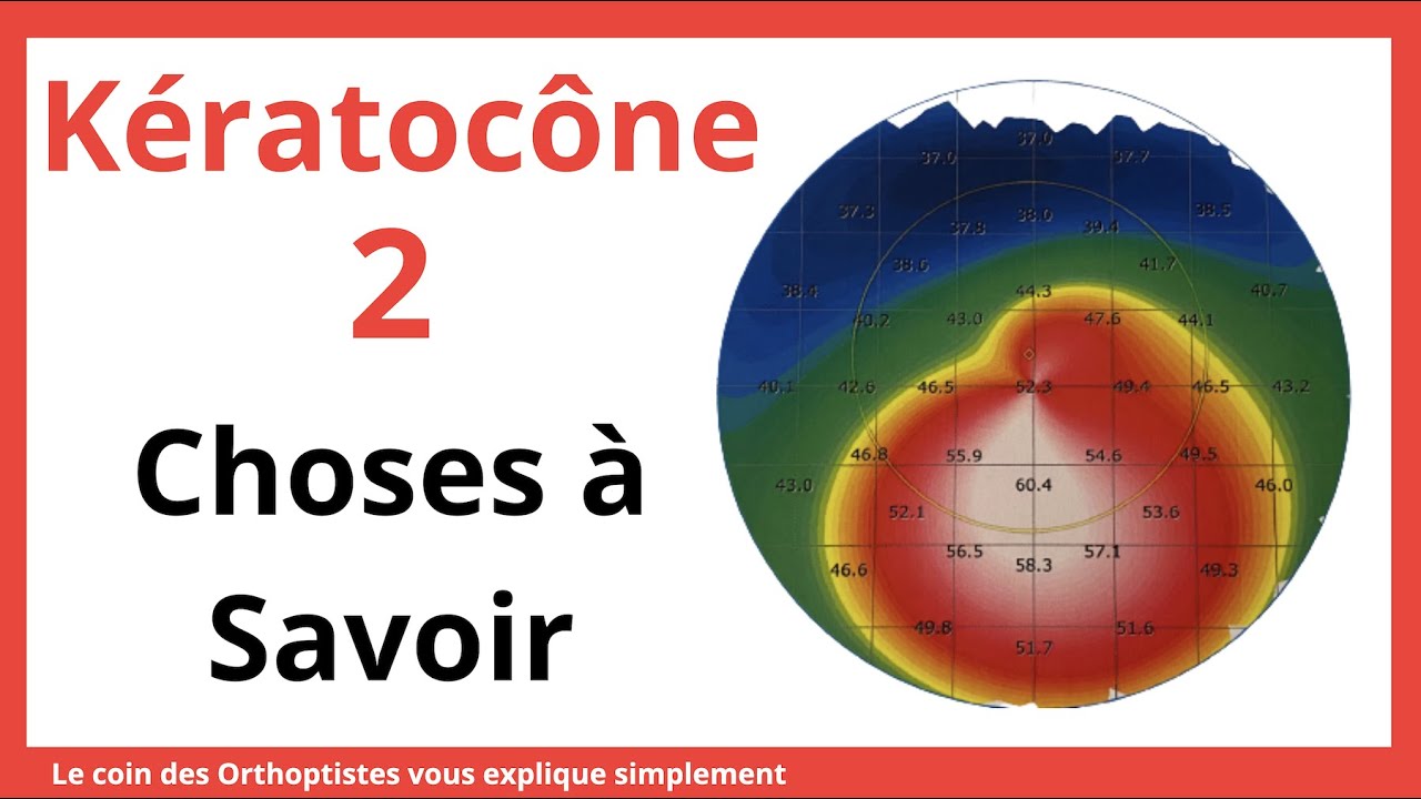 Comment soigner un kératocône ? Comment savoir si on a un kératocône ?