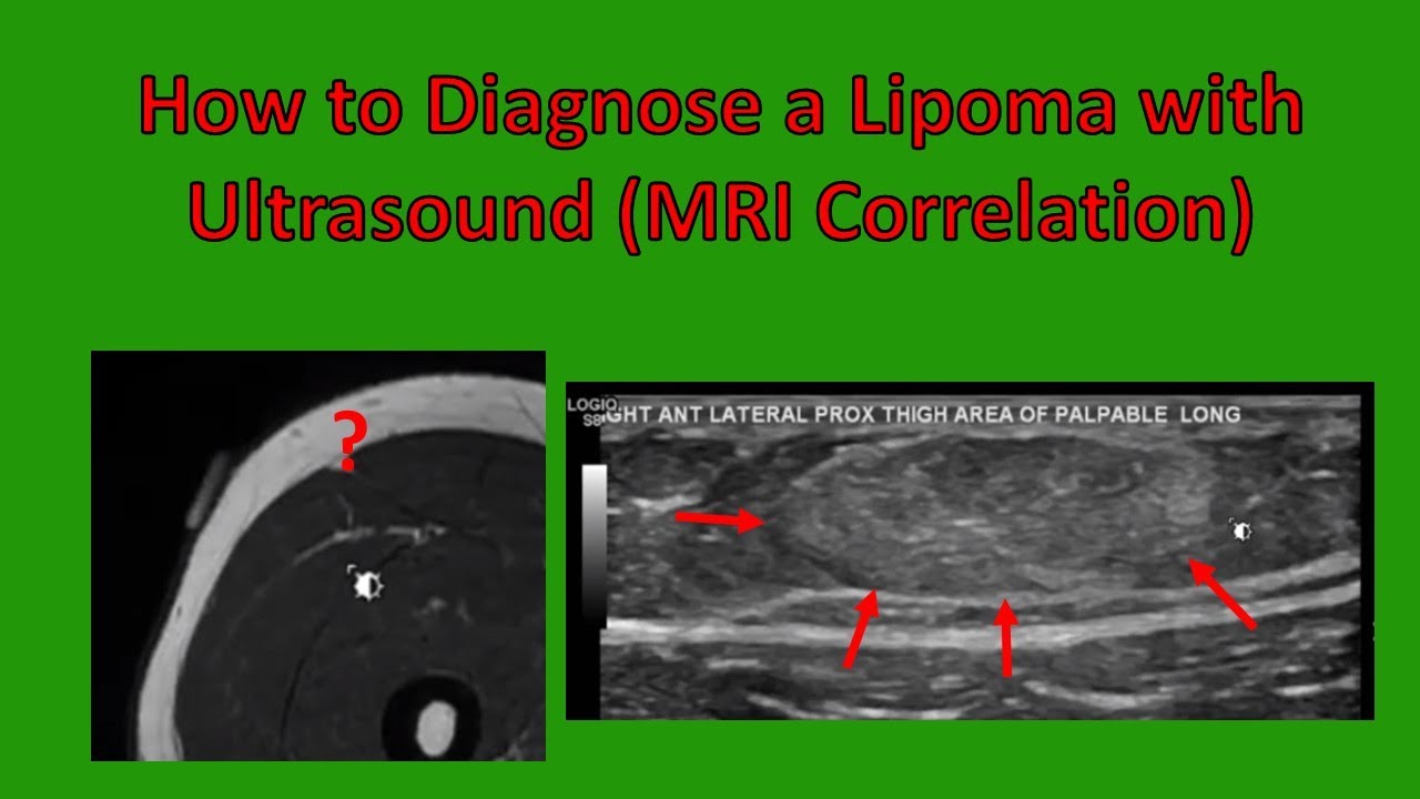 Lipoma Ultrasound Characteristics (Updated 2020)