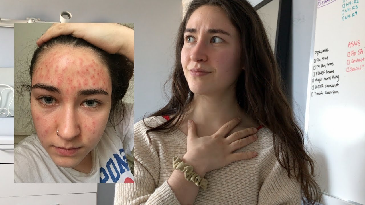 I went on Accutane 4 times... (yep, it's true)