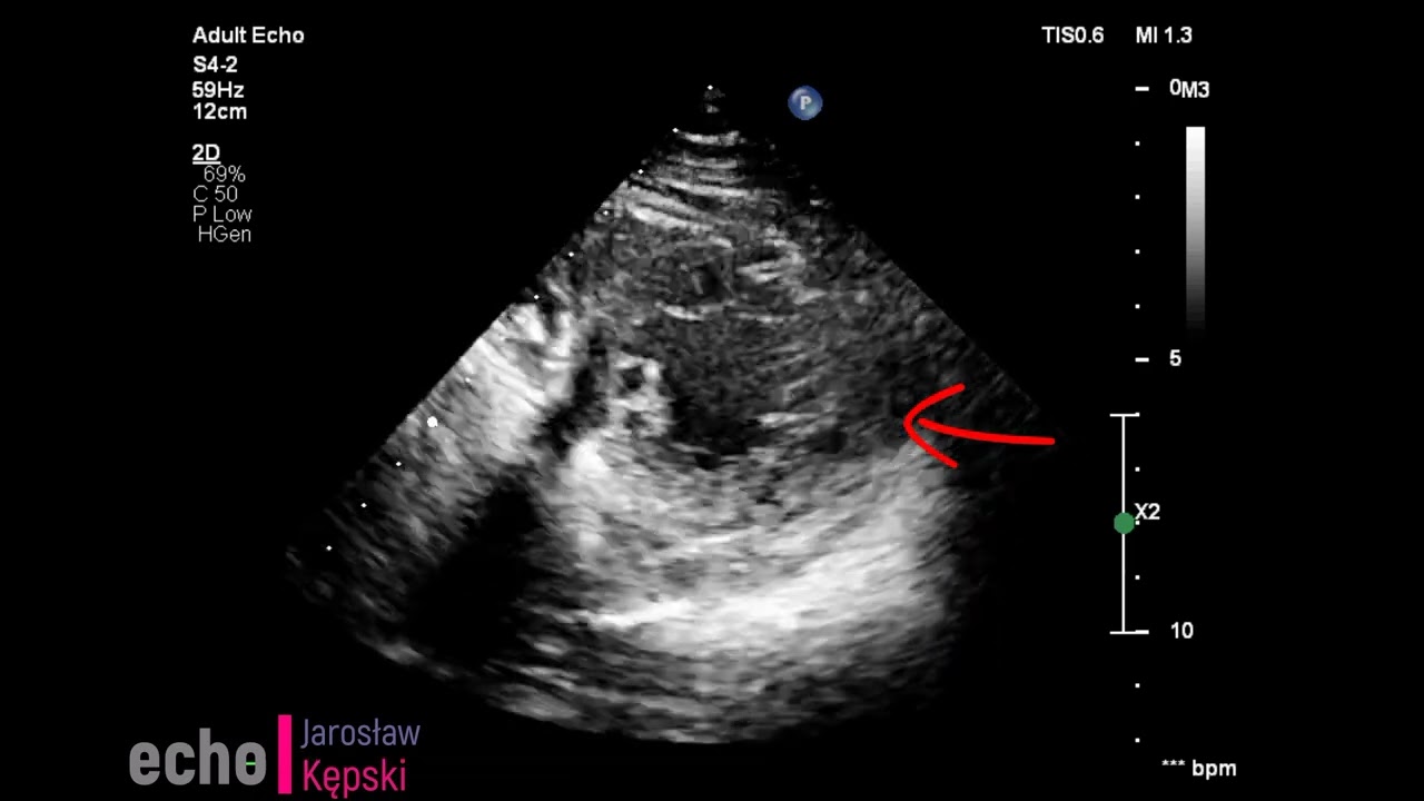 left ventricular non-compaction cardiomyopathy (lvnc) echocardiography and electrocardiogram