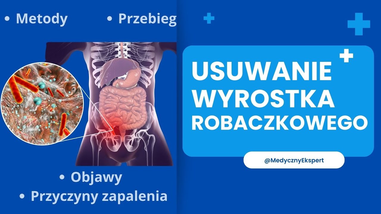 Wycięcie wyrostka robaczkowego: Diagnoza, Objawy i Leczenie