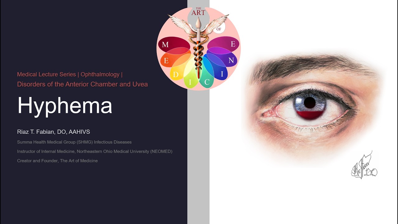 Hyphema | Ophthalmology | Medical Lecture Series