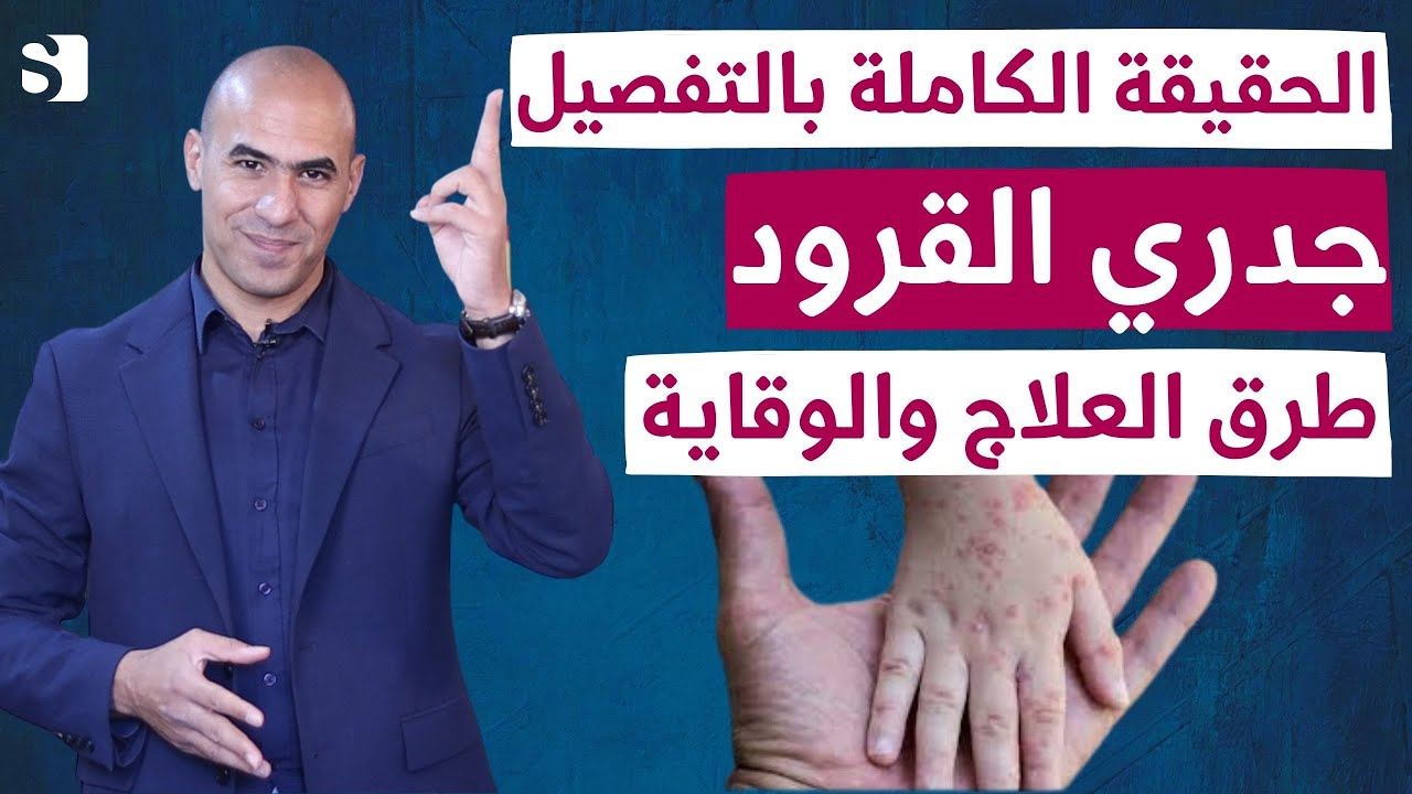 جدري القرود وكل ما يجب معرفته عن هذا الفيروس النادر لوقاية نفسك واطفالك | لن تقلق بعد ان تعرف