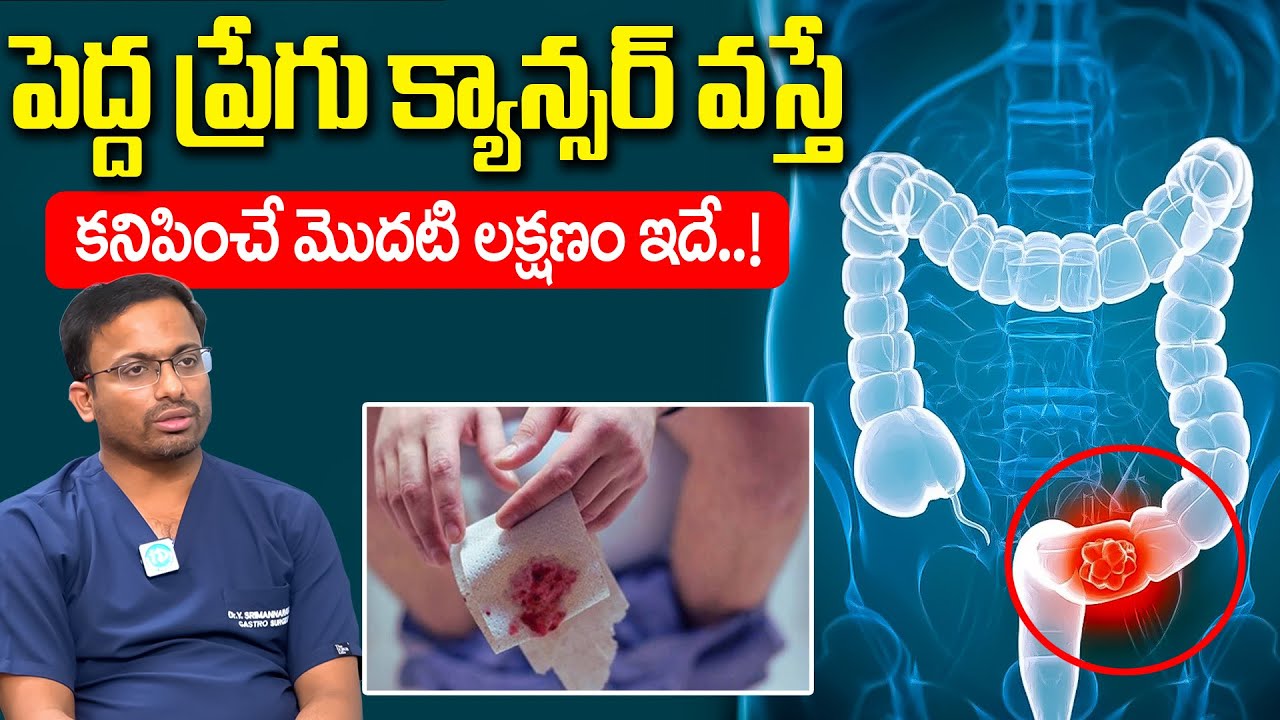 పెద్ద ప్రేగు క్యాన్సర్ వస్తే కనిపించే మొదటి లక్షణం ఇదే.! | Colon Cancer Symptoms | Dr Srimannarayana