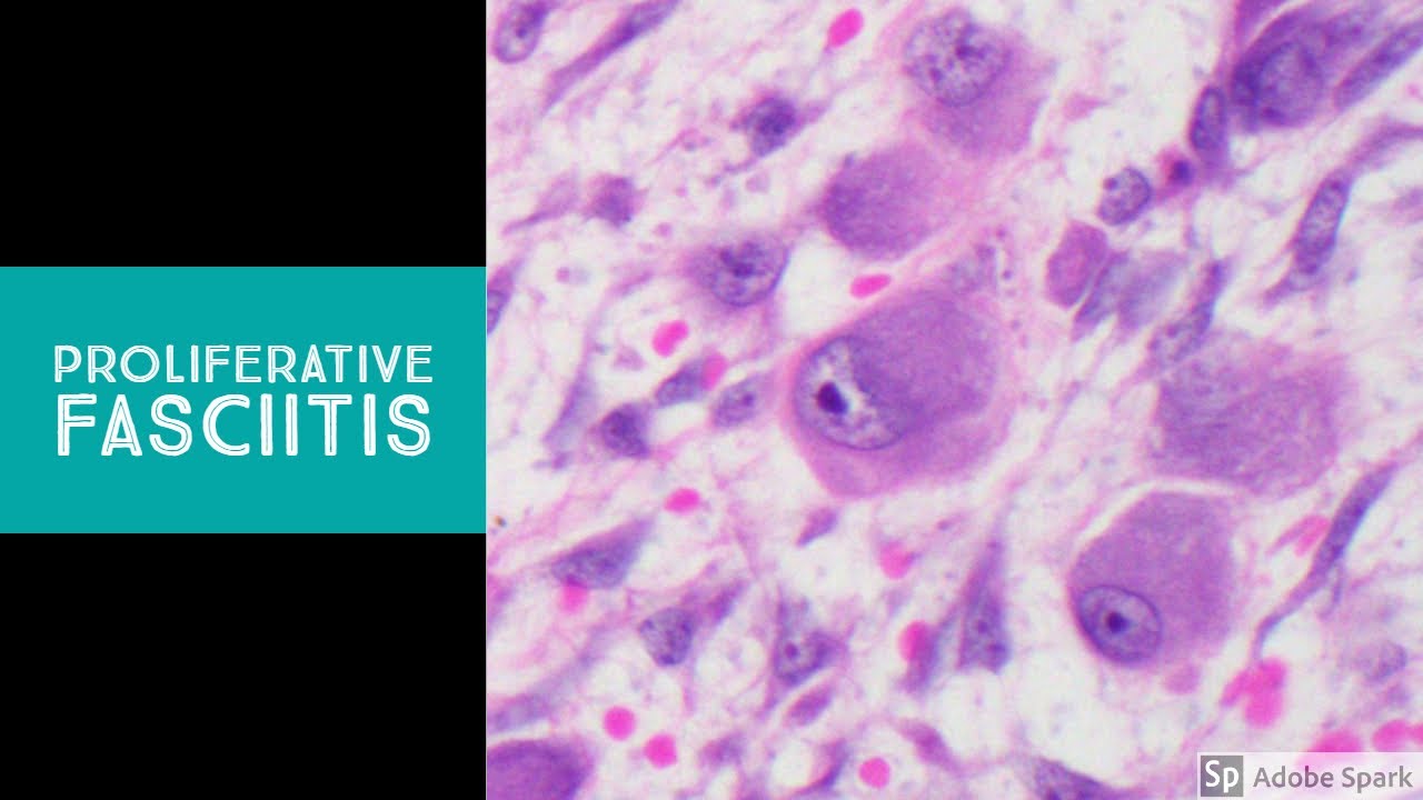 Proliferative Fasciitis & Myositis...Explained by a Soft Tissue Pathologist