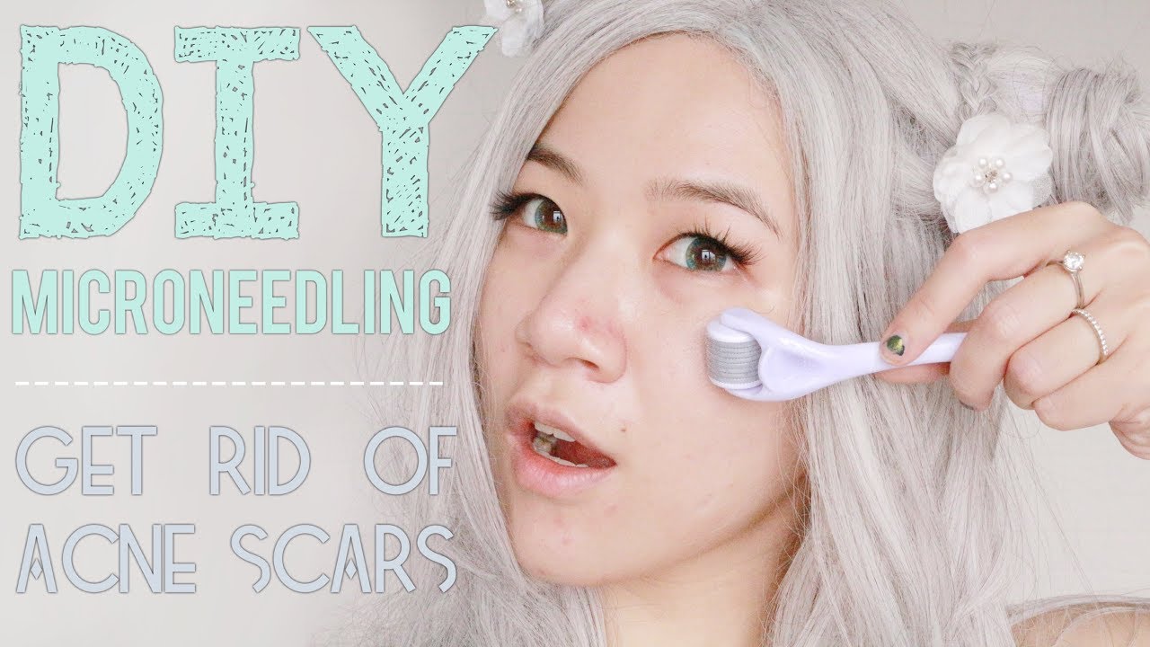 DIY MICRONEEDLING | How To Get Rid Of Acne Scars!