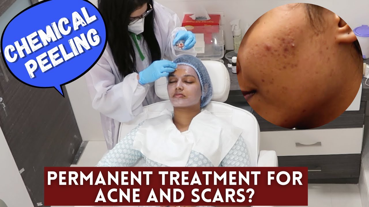 I got STRONG Chemical Peeling at the Clinic for ACNE | Is it a Permanent cure?
