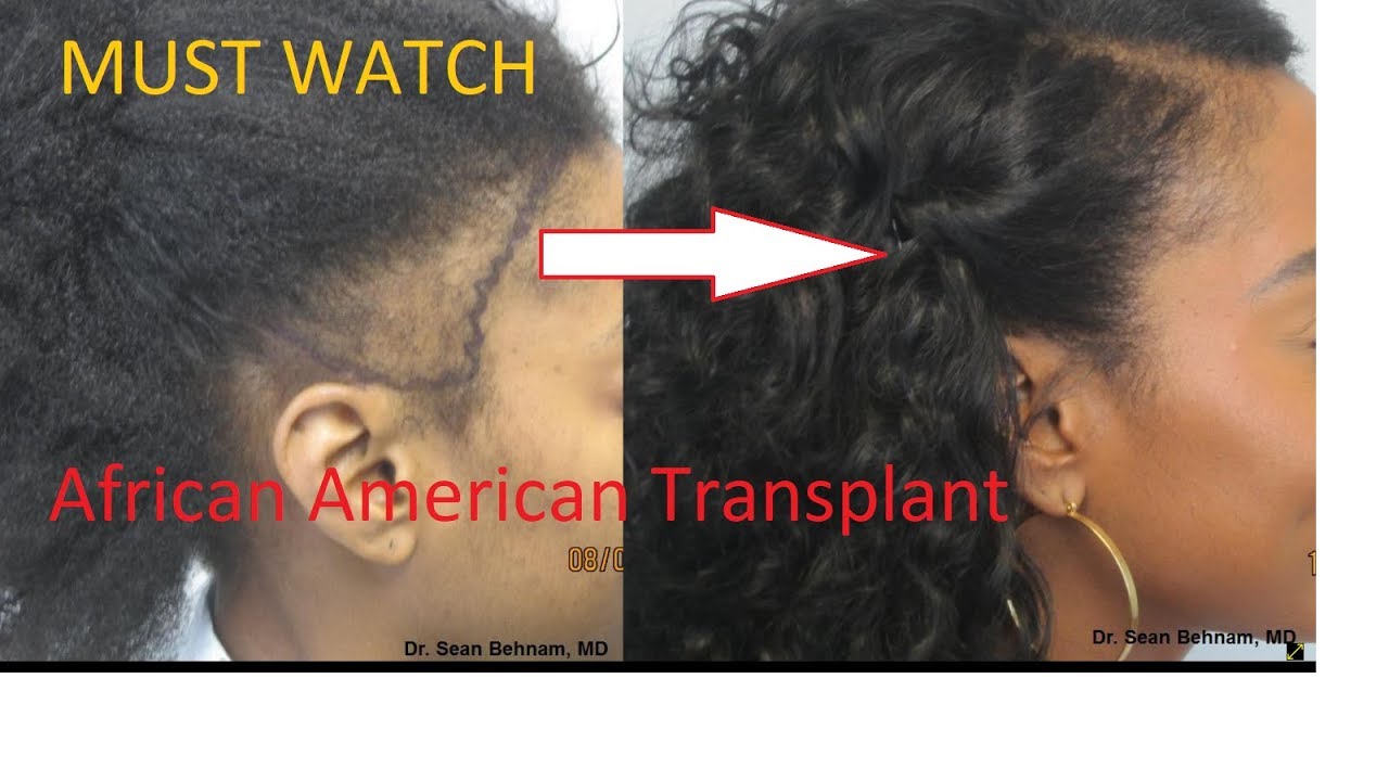 African American Hair transplant and Hair Restoration In Los Angeles