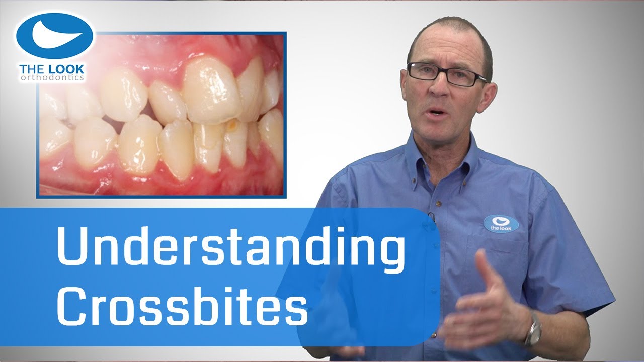 Understanding Crossbites