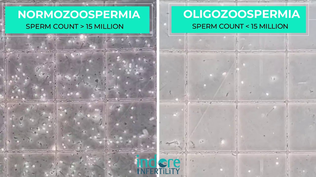 Oligozoospermia - Low Sperm Count. Comparison of Normal Semen Sample with sample with Low Count.