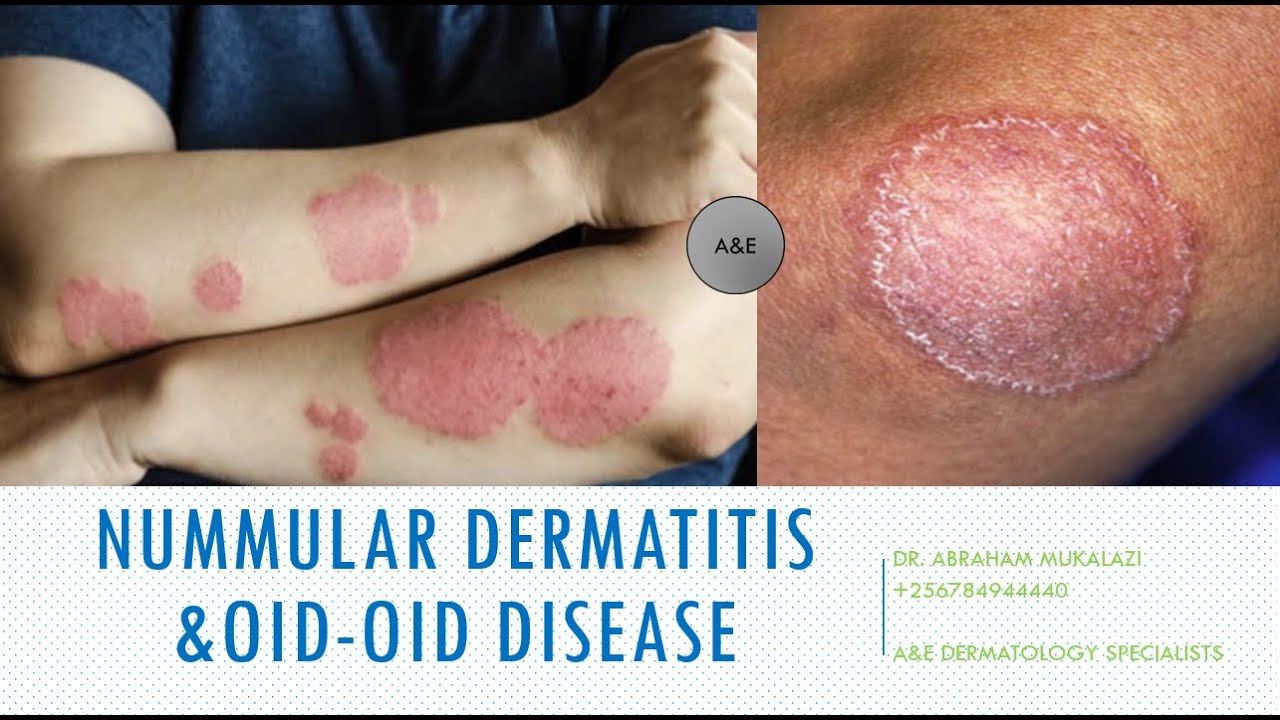 NUMMULAR DERMATITIS EXPLAINED BY DR ABRAHAM 