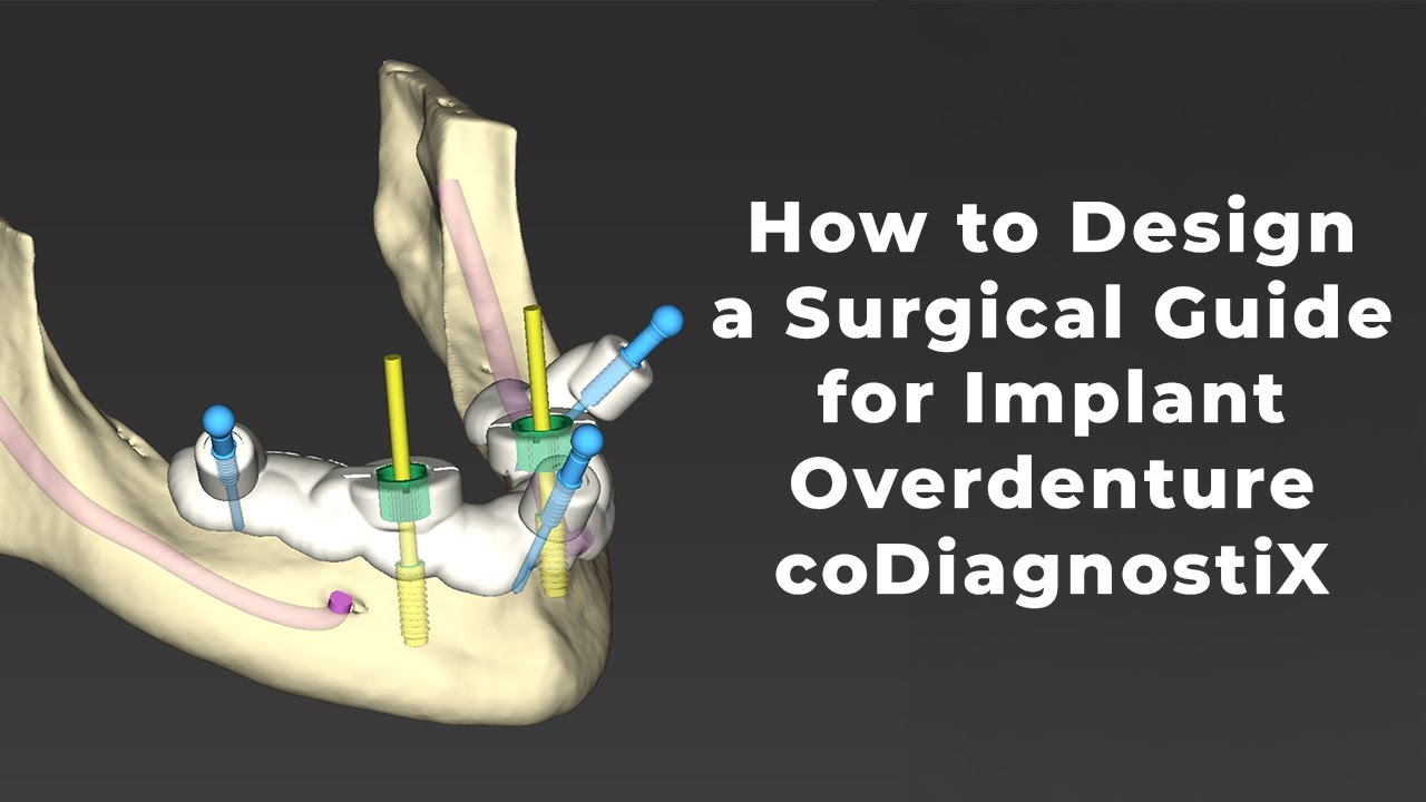 Placing Implants & Designing a Surgical Guide for an Implant Overdenture | coDiagnostiX Workflow