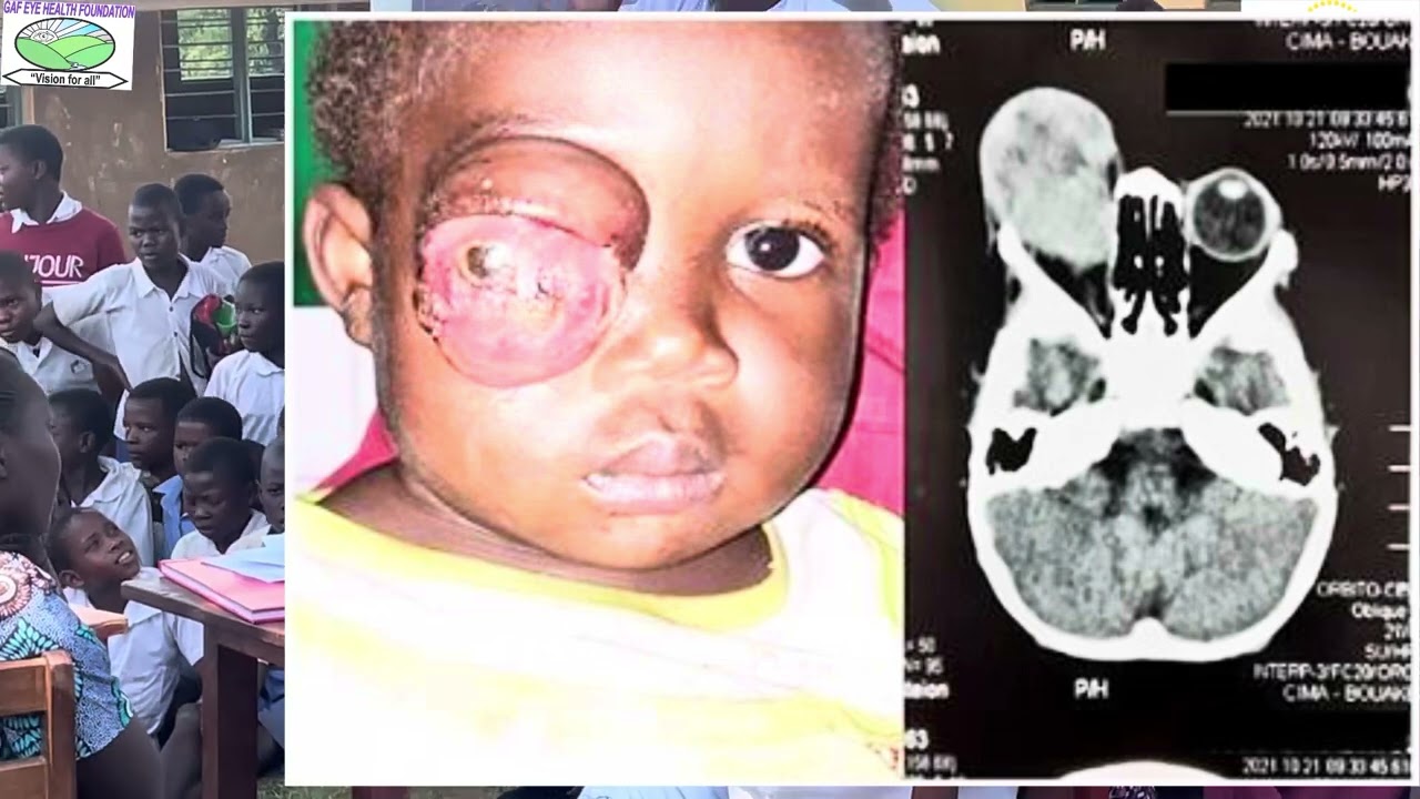 Our new song about eye cancer- Retinablastoma