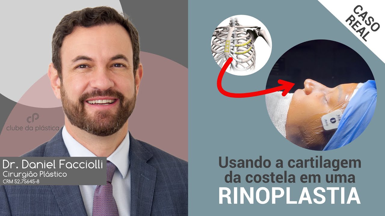 Clube da Plástica: Usando a cartilagem da costela em uma rinoplastia - caso real