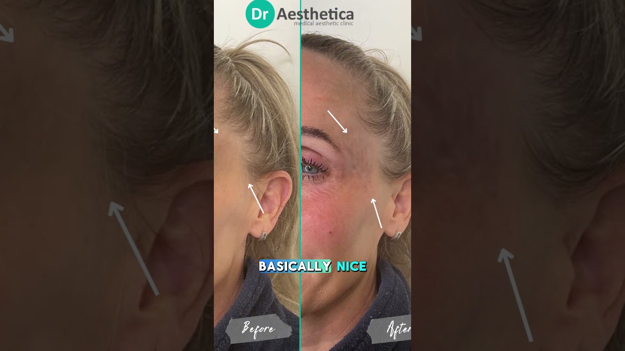 Just Had Temple Filler? Aftercare Tips from Dr. Farmah