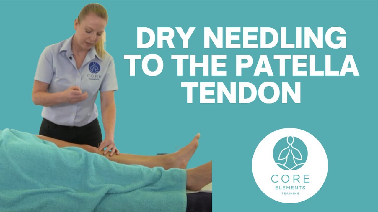 Dry Needling to the Patella Tendon