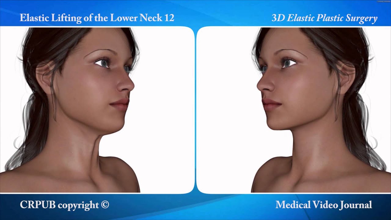 3D Elastic Lifting of the Lower Neck 12