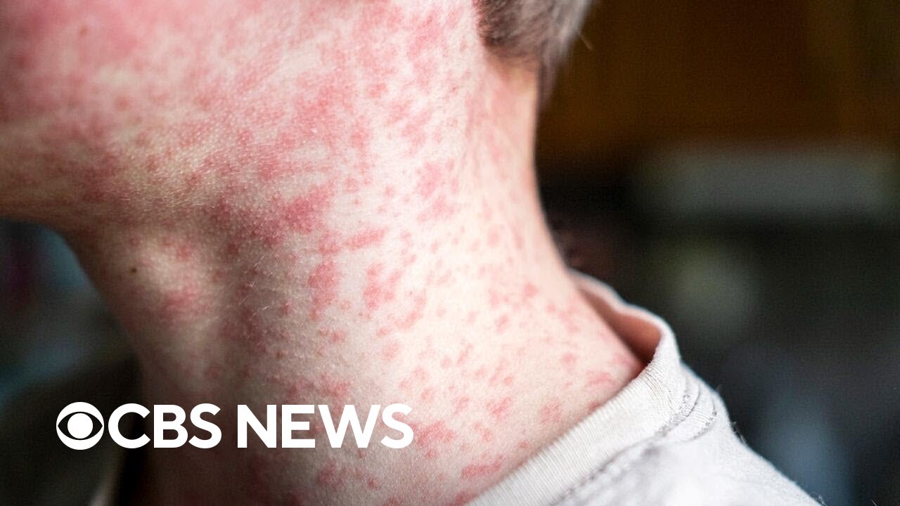 South Carolina confirms 138 cases of measles amid outbreak