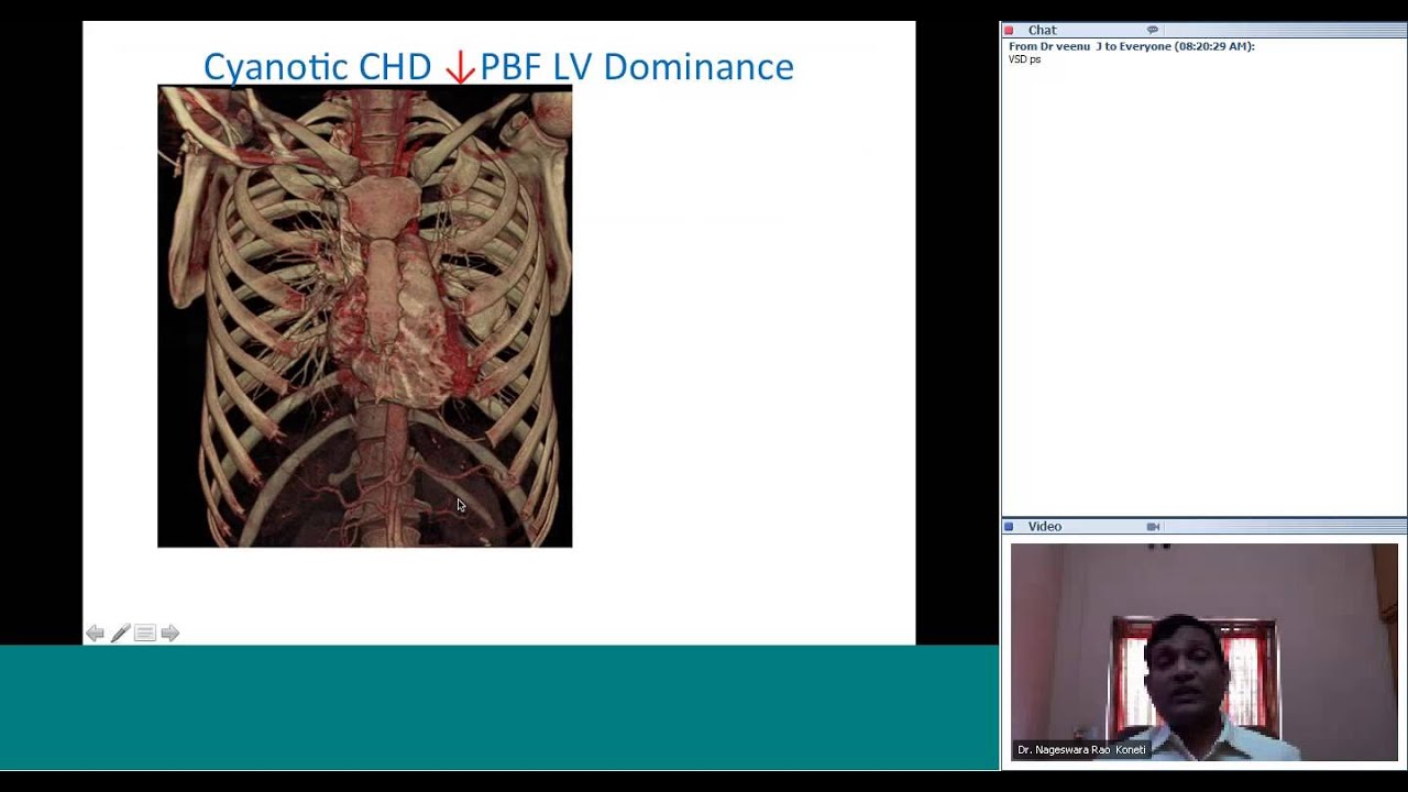 Approach to Cyanotic CHD by Dr Nageswara Rao