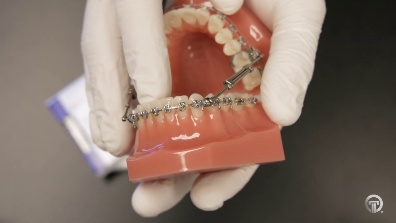 TruEase Class II / III Bite Corrector | Ortho Technology