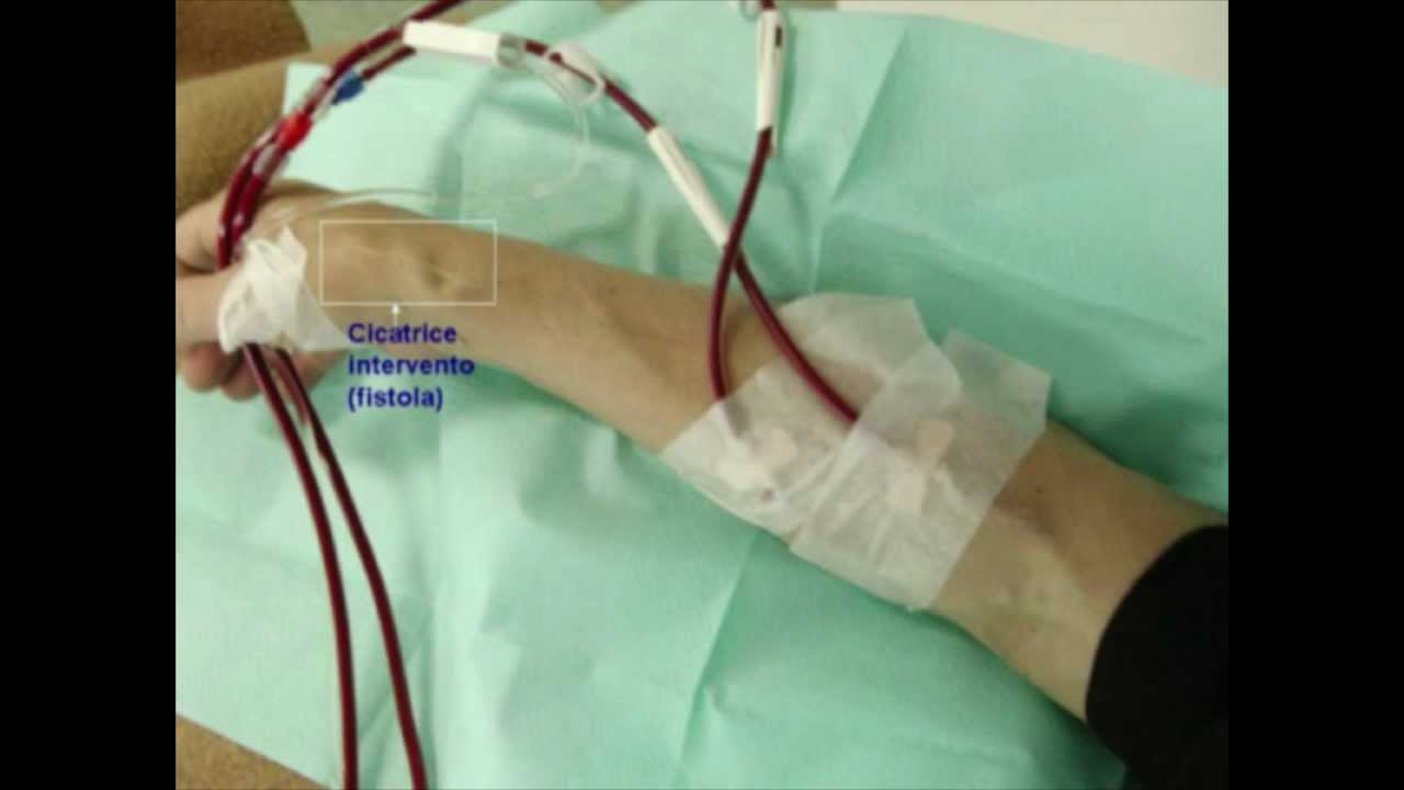 L'accesso vascolare per dialisi: la fistola