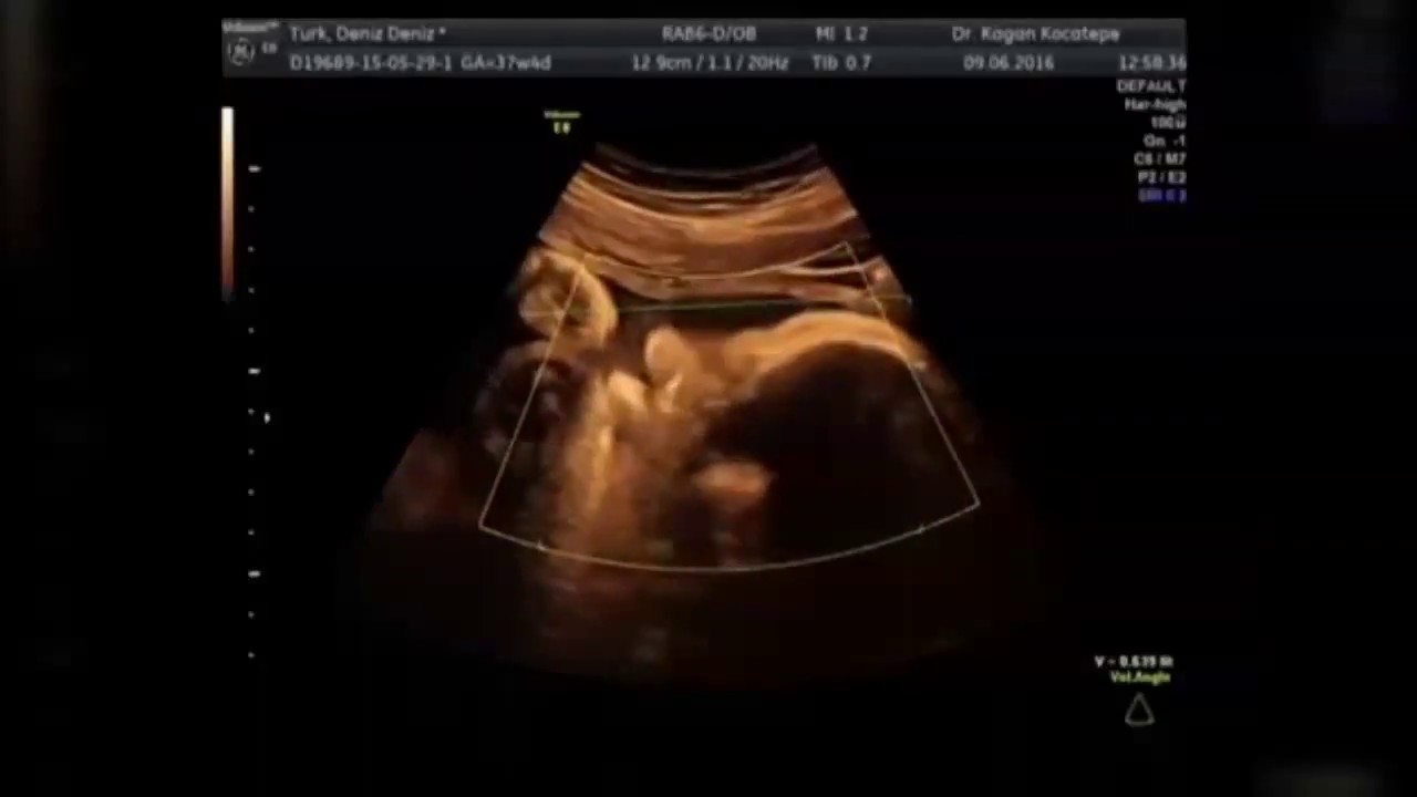 37 haftalık gebelik. Ultrason anne karnındaki bebeğin kaç kilo olduğunu nasıl hesaplar?
