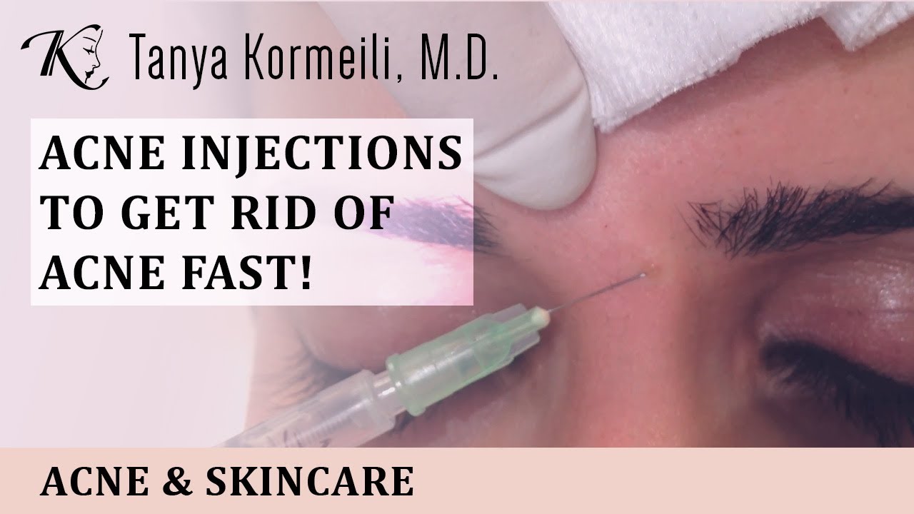 Acne Injections - Quick Treatment to get rid of acne!