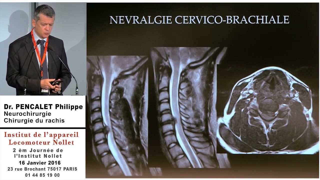 Docteur PENCALET Philippe   Quand opérer un rachis cervical dégénératif ?