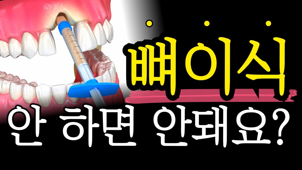 *제발 명심하세요!!!* 임플란트 뼈이식 비용ㅣ후기ㅣ통증 싹 다 알려드립니다