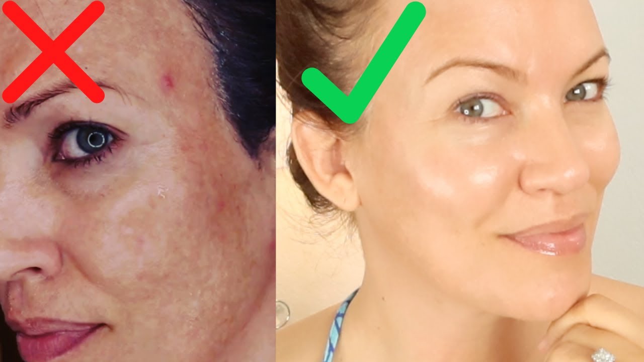 GET RID OF HYPERPIGMENTATION,  MELASMA & DARK SPOTS! What your Dr may NOT be telling you!