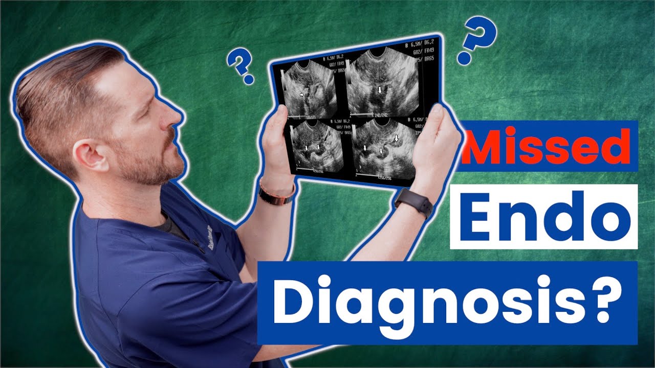 Why doctors miss the diagnosis for endometriosis