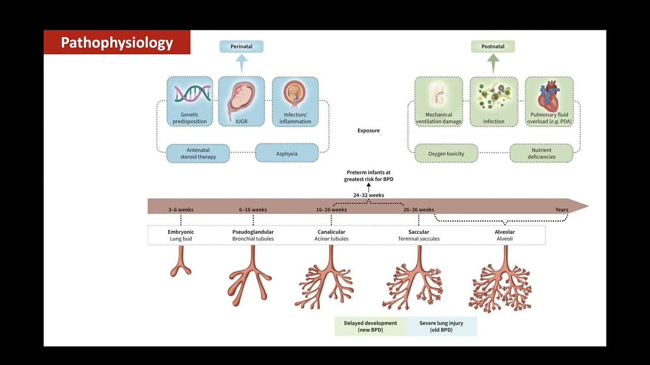 Brochopulmonary Dysplasia : Current Evidence and Practice