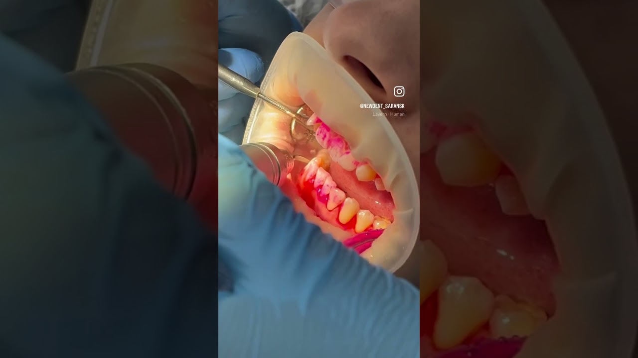 Профчистка зубов методом Air-Flow в New Dent 🦷🤍 #newdentsaransk #профчистка #airflow #saransk