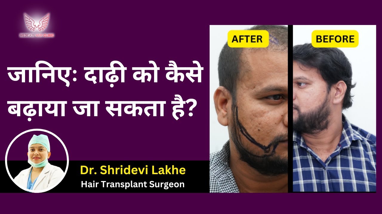 जानिएः दाढ़ी को कैसे बढ़ाया जा सकता है? | How To Boost Beard Growth | Dr. Shridevi Lakhe