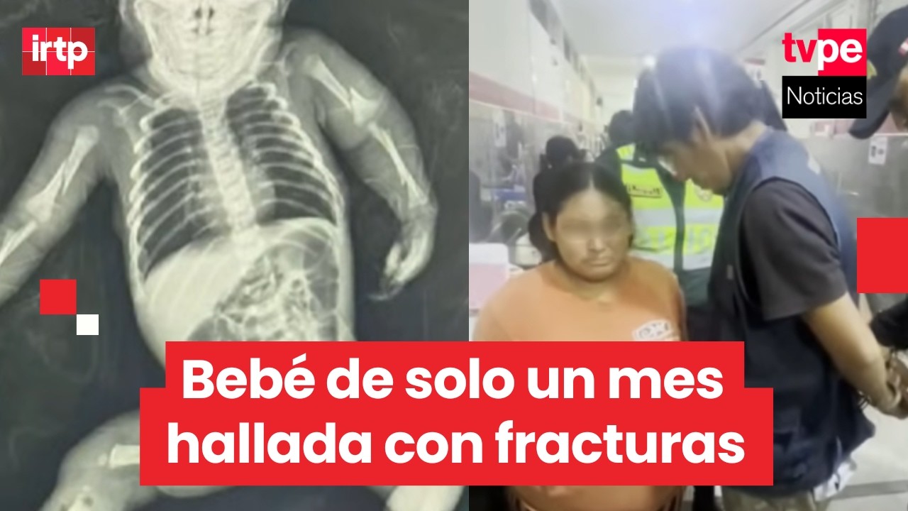 Chimbote: detienen a padres de bebé de un mes con fracturas y desnutrición