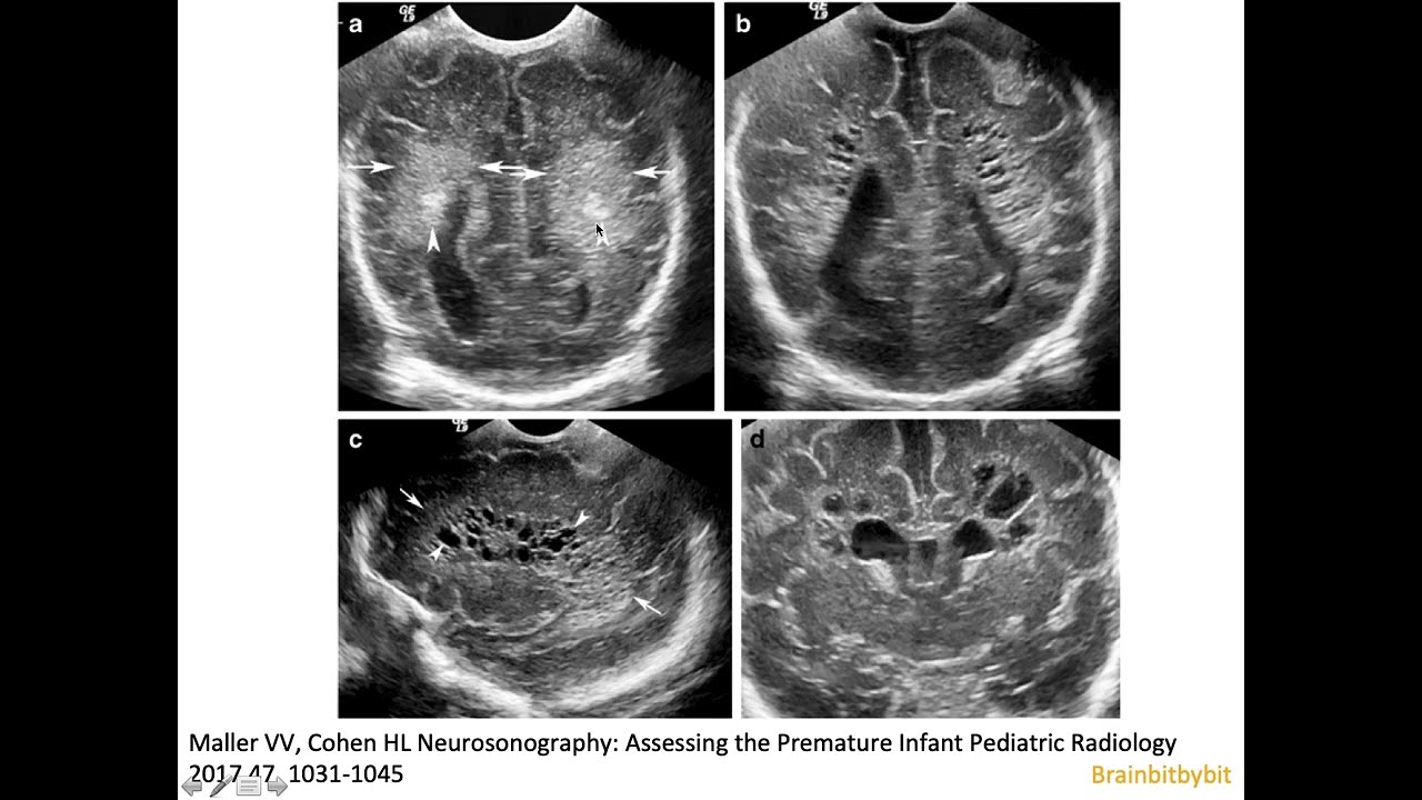 13. Periventricular leukomalacia on neonatal ultrasound; white matter injury of prematurity, DESHI