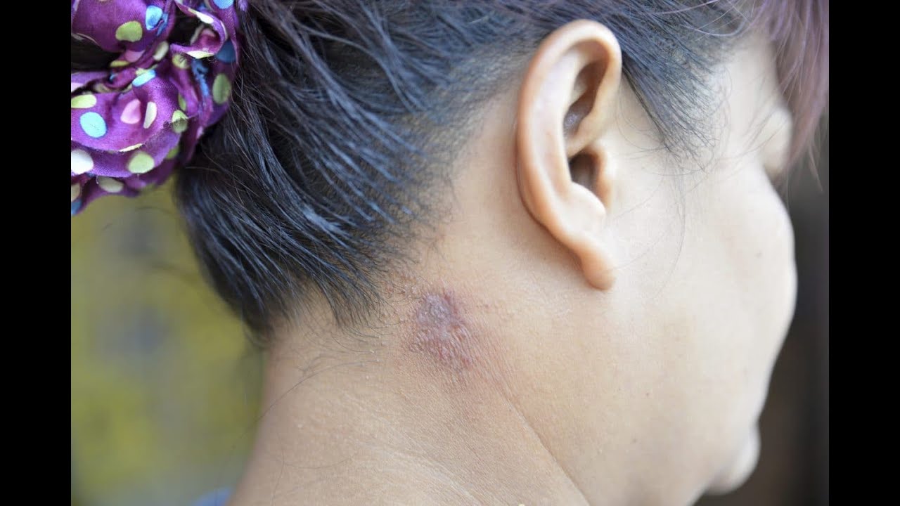 Excision of skin lesions CPT code - simplify medical coding