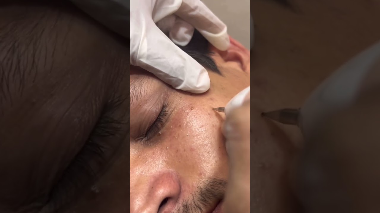 Milia Removal treatment# skincareforacneproneskin