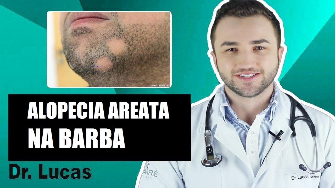 Alopecia Areata na Barba (Falhas Grandes na Barba) - Dr Lucas Fustinoni