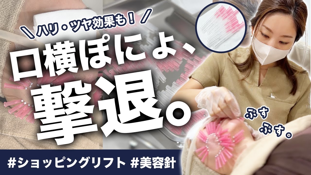 【たるみ・毛穴】ショッピングリフトで口横ぽにょ・ほうれい線撃退💥