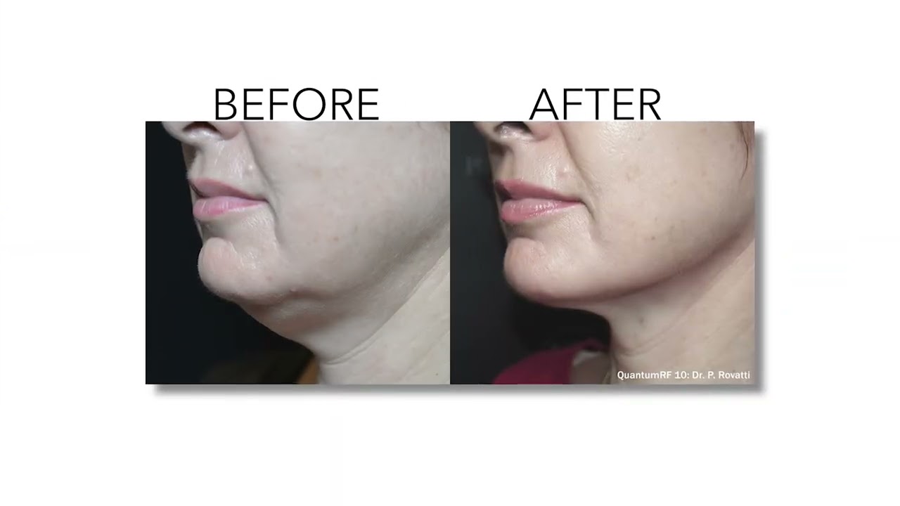 Nonsurgical Skin Tightening with Quantum RF | Quantum RF in Oak Ridge, TN