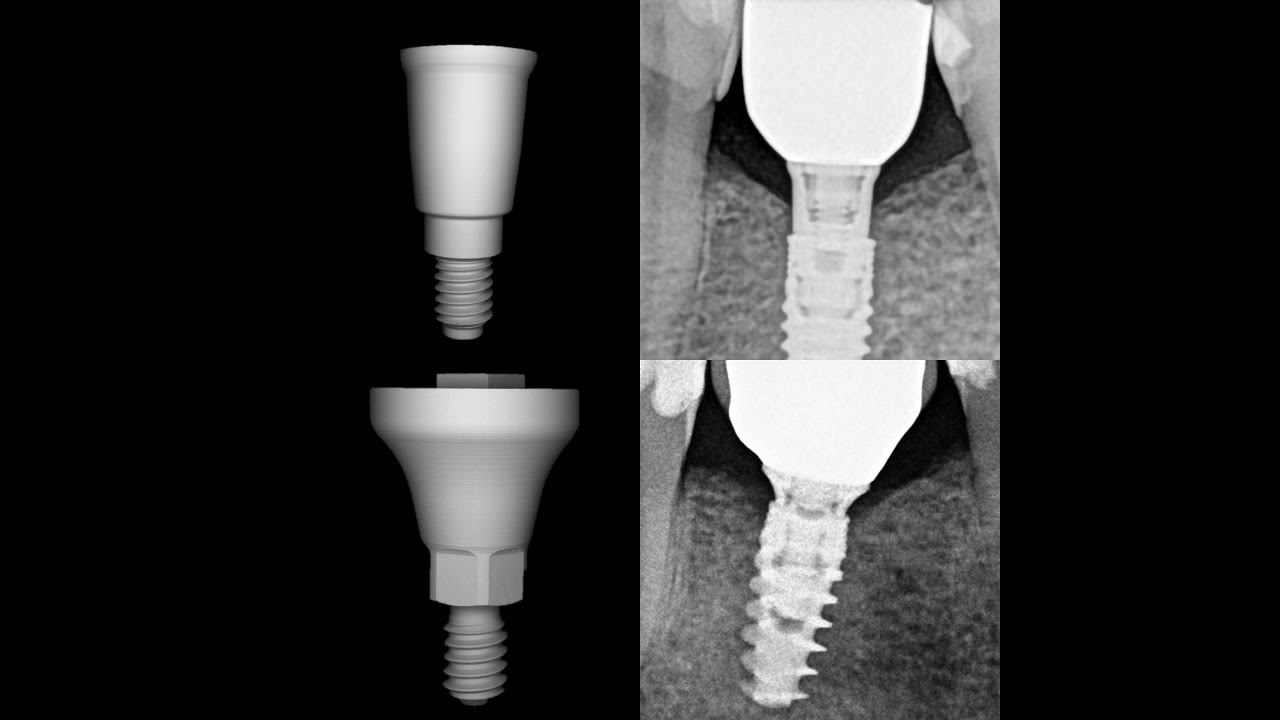 MIS implant secret