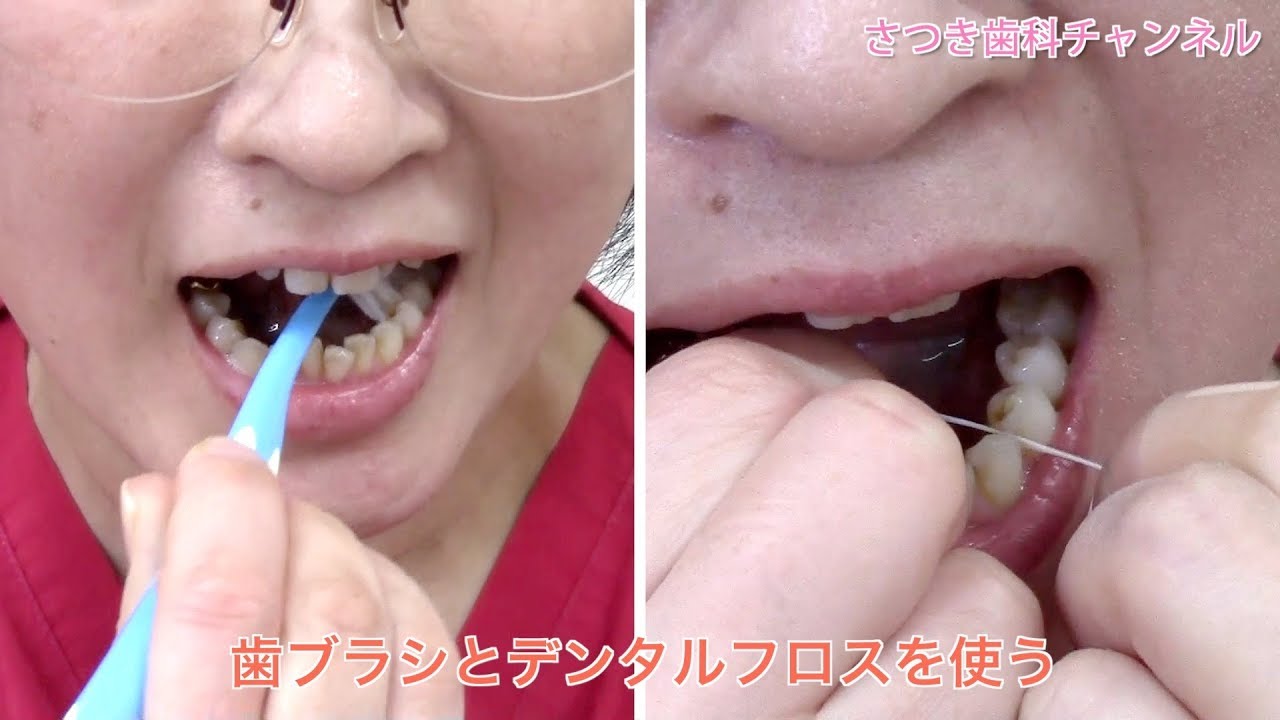 【青森_十和田市_歯医者】舌の口内炎をすぐ治す方法！_さつき歯科チャンネル031（口腔ケアチャンネル）