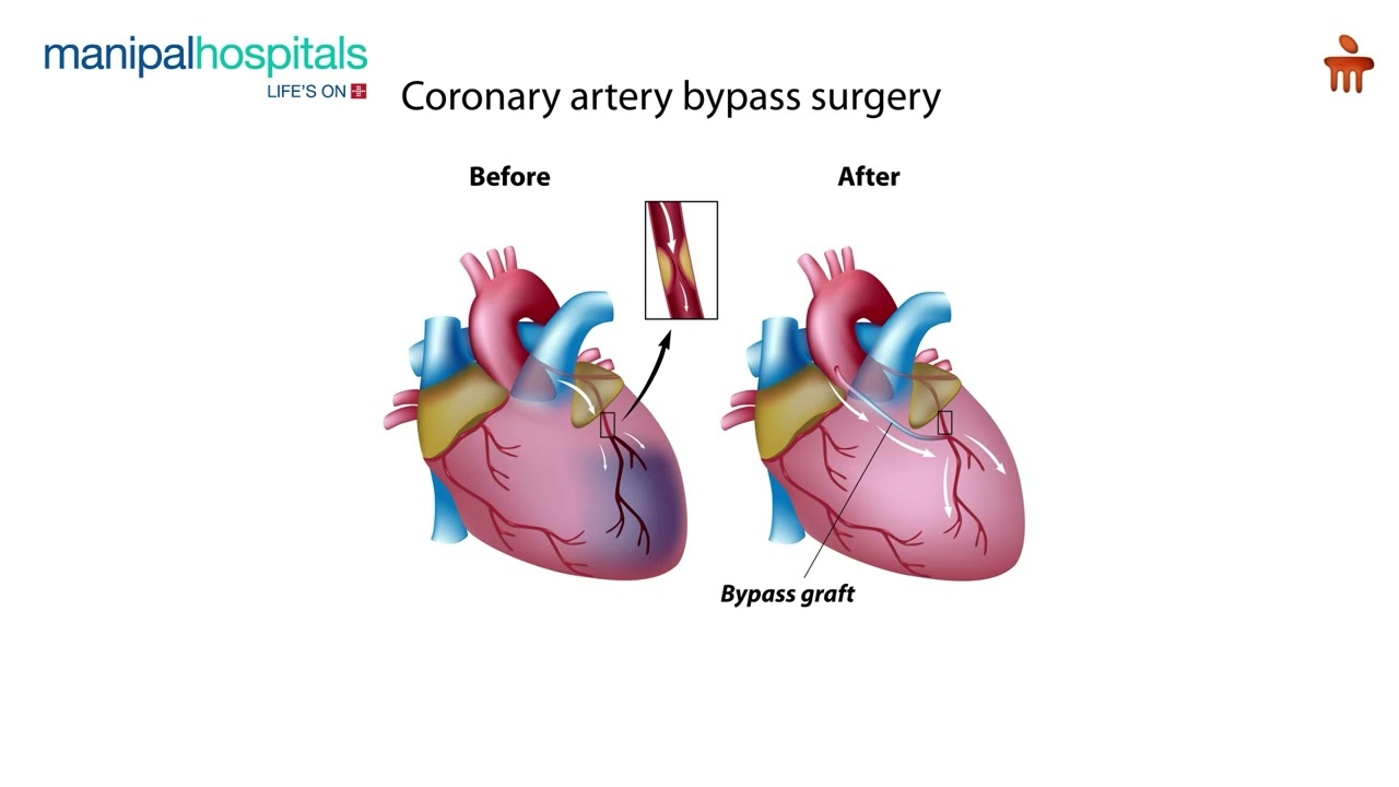 How Minimally Invasive Cardiac Surgery Works | Dr. Kaushik Mukherjee | Manipal Hospital Dhakuria