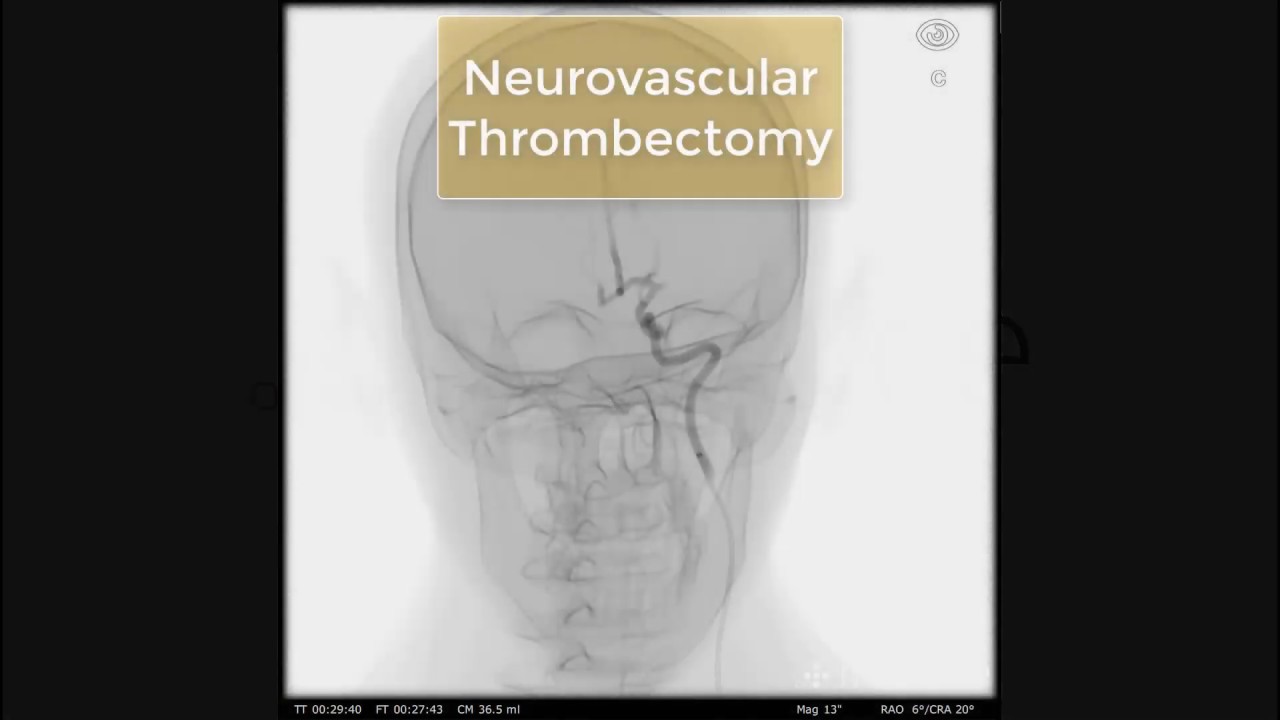 Mentice Neurovascular Thrombectomy