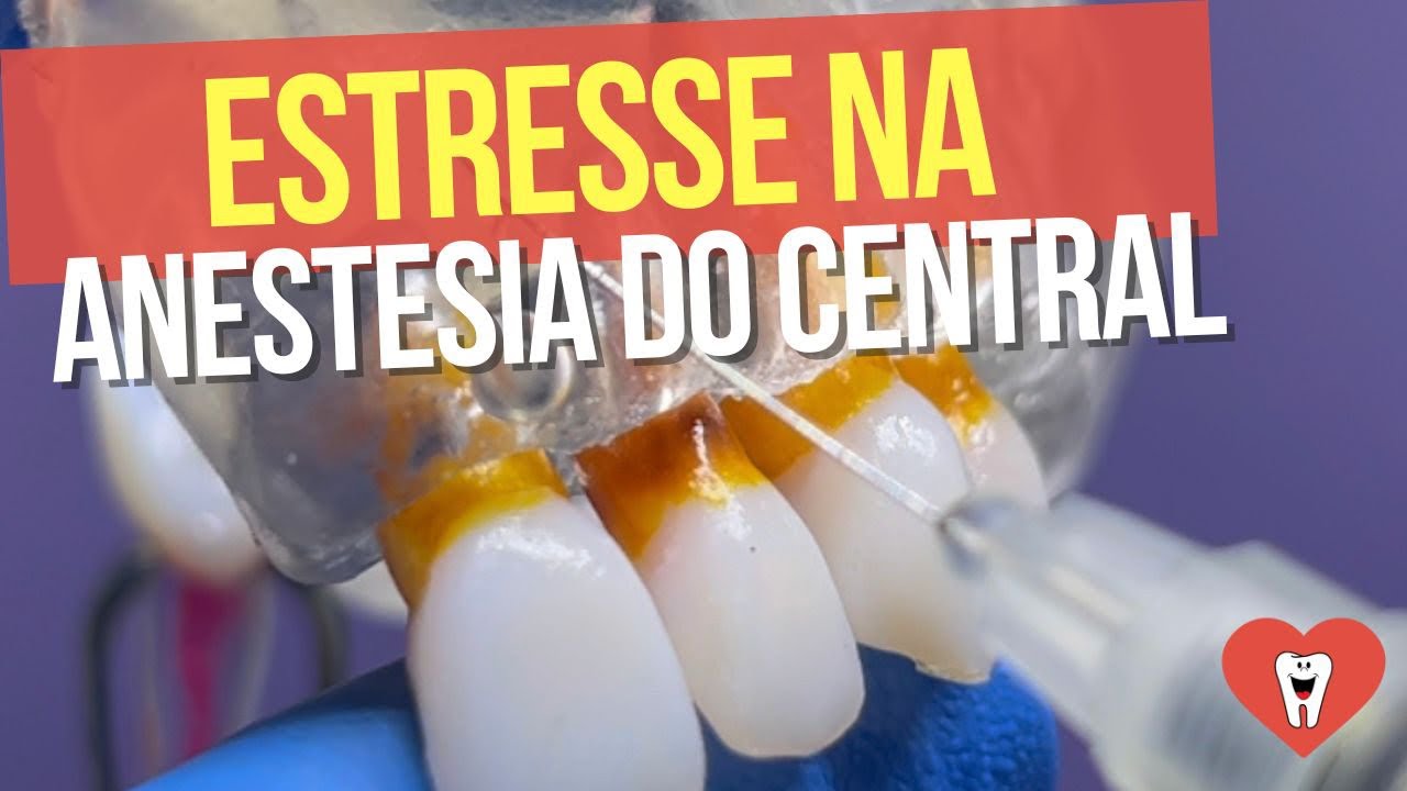 VOCÊ VAI ESTRESSAR SEU PACIENTE ERRANDO ISSO NA ANESTESIA DE INCISIVO CENTRAL SUPERIOR!