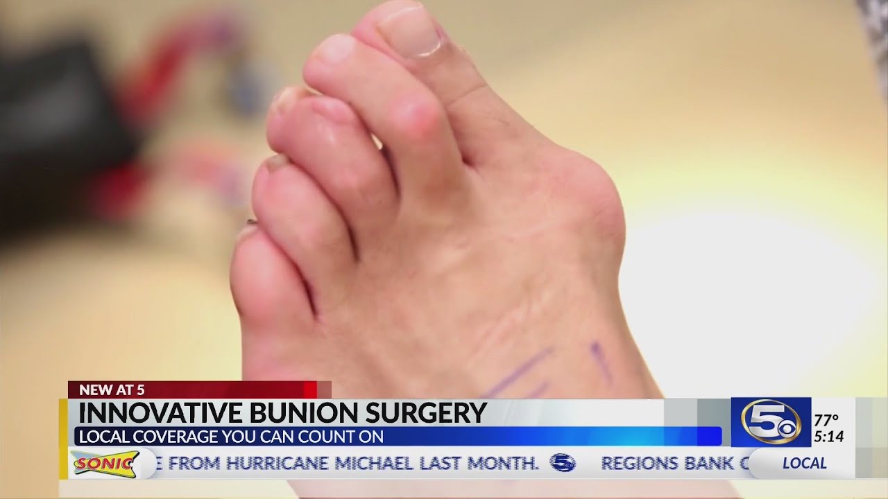SPECIAL REPORT: New bunion surgery cuts recovery time