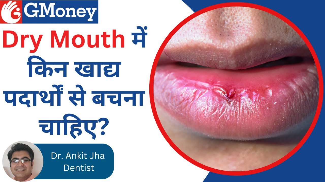 मुंह सूखने के कारण और इलाज  (Dry Mouth) - GMoney Health Show