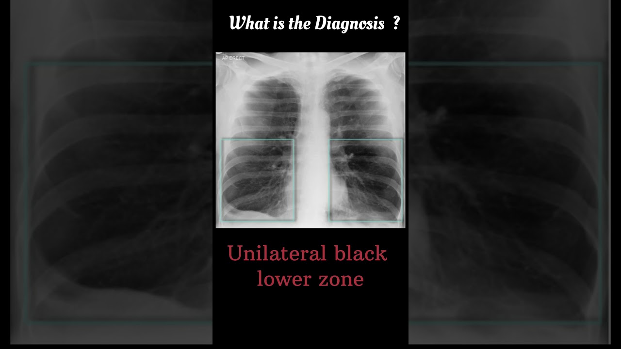 chest x-ray Quiz 11 #