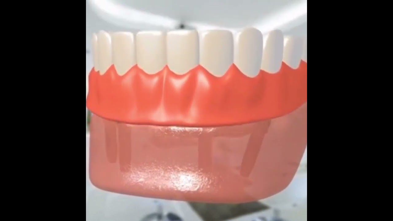 Teeth In A Day Express - Same Day Dentures - Near Woodlands, TX | Partners Dentures and Implants